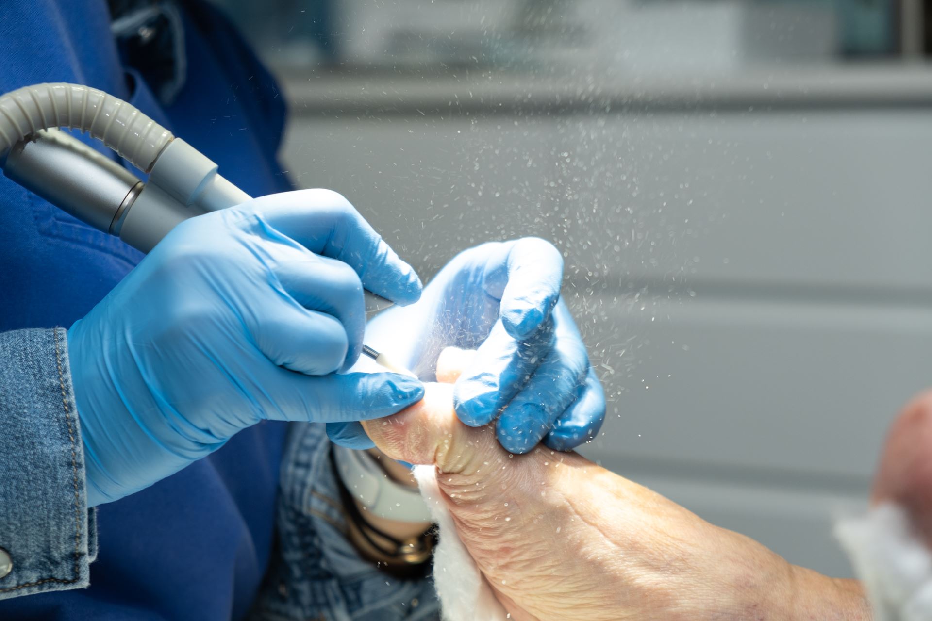 Pédicure pour ongle incarné à Luxembourg Ville
